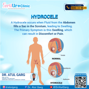 hydrocele